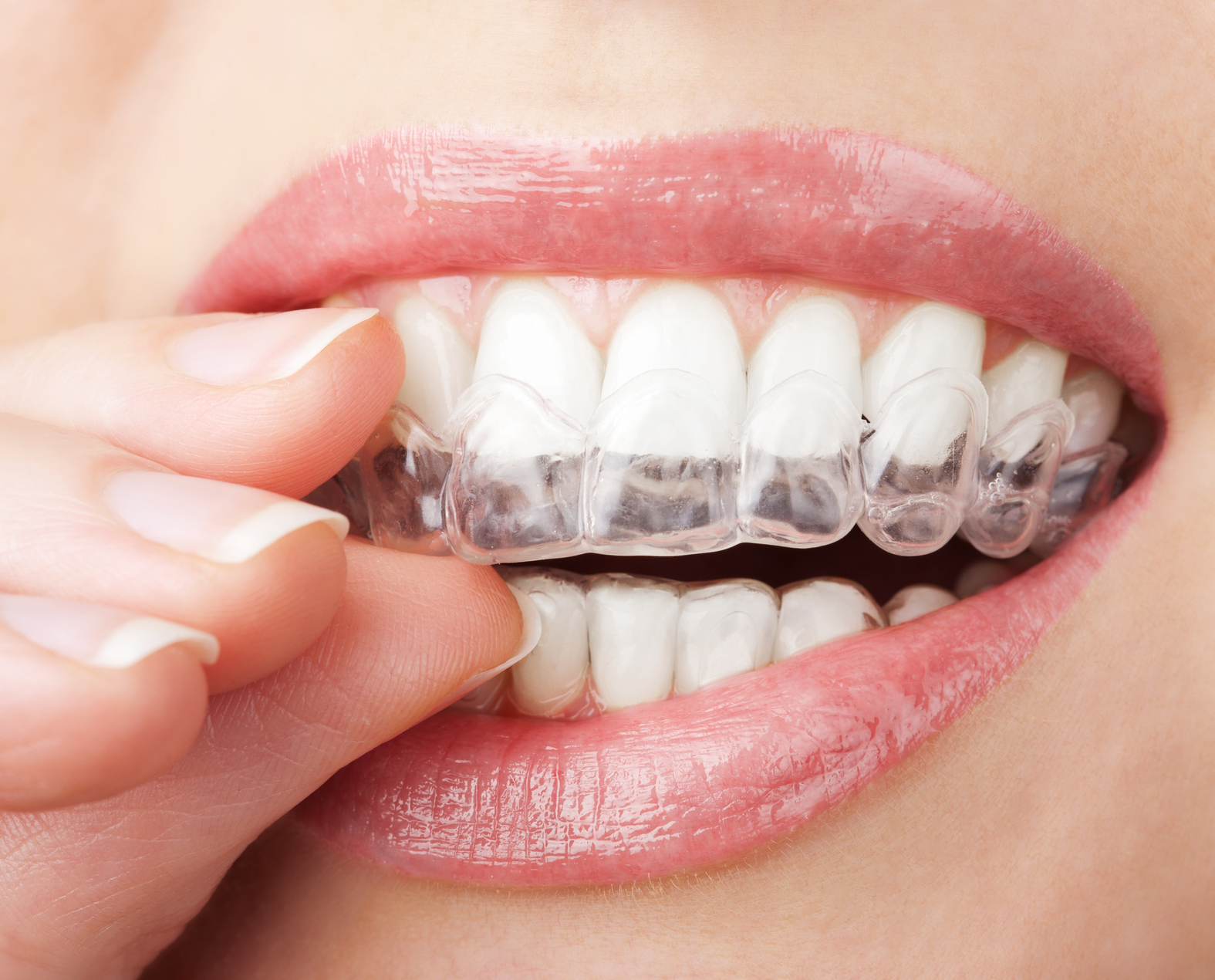 Alinhadores transparentes Invisalign